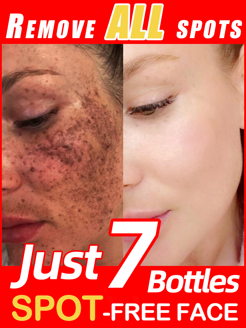 تفتيح النمش الكلف، البقع الداك - مراجعة Luxury Skincare Essence وسعره